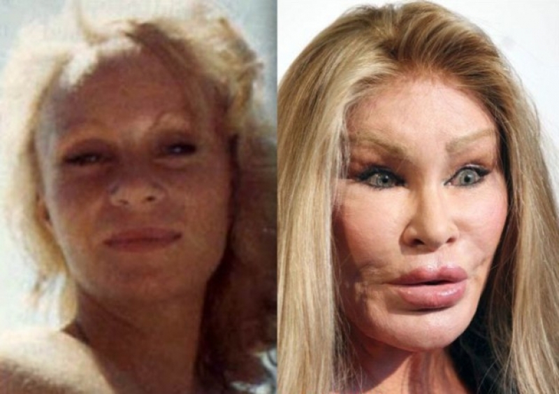 catwoman-plastic-surgery-gone-wrong-celebrity-plastic-surgery-gone-wrong-new-york-catwoman-plastic-surgery-real-life-catwoman-plastic-surgery-picture-of-catwoman-plastic-surgery.jpg